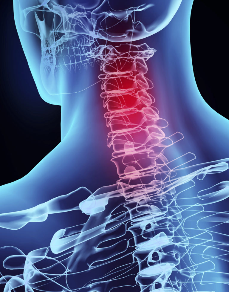 3D illustration x-ray neck painful.